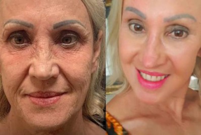 Cuidados antes de fazer o peeling de fenol 