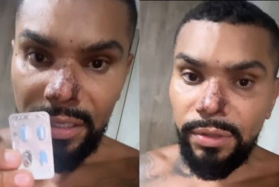 Naldo Benny faz tratamento com 'azulzinho' após princípio de necrose no nariz