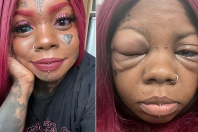 Mulher pode perder a visão após tatuar globo ocular de azul e roxo