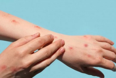 Rio tem 1.360 casos de varíola dos macacos confirmados 