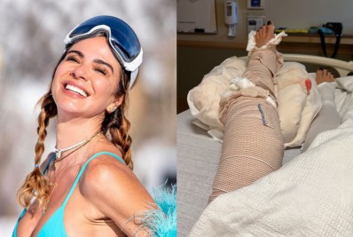 Luciana Gimenez mostra a perna imobilizada após acidente na neve