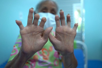 Campanha Janeiro Roxo luta contra preconceito referente à hanseníase