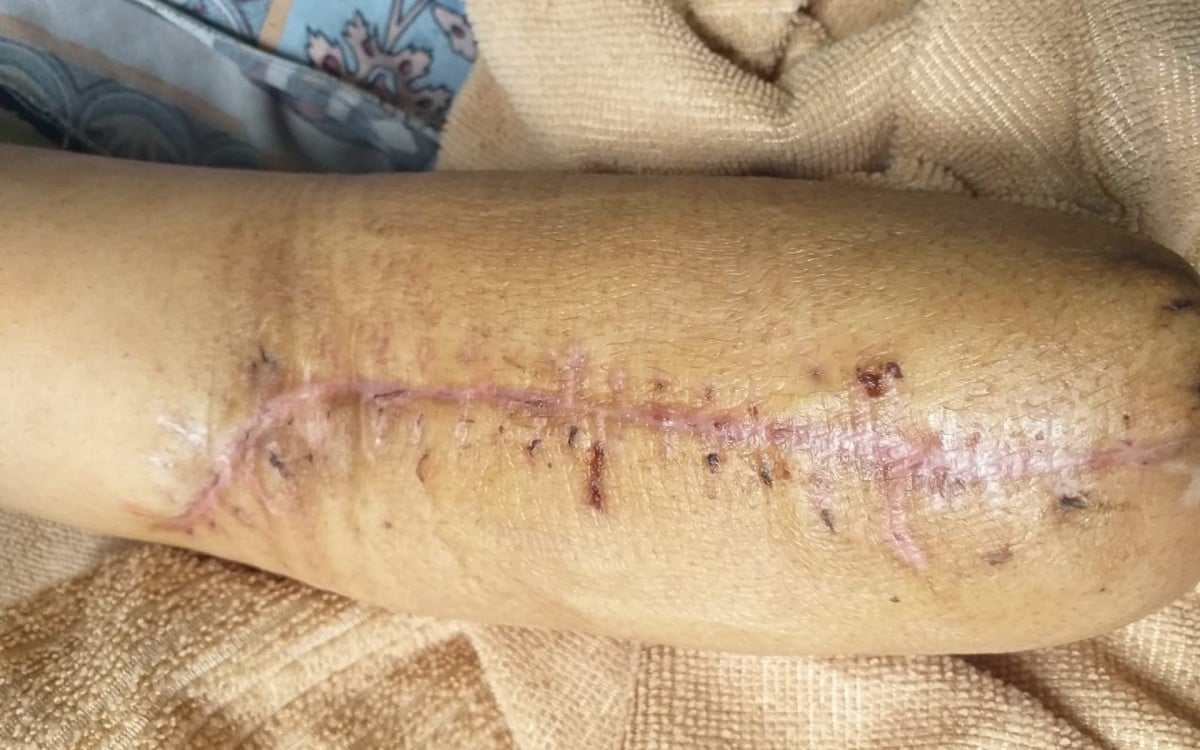 Paciente teve o braço amputado, mas não sabe o que levou a perda do membro - Arquivo pessoal