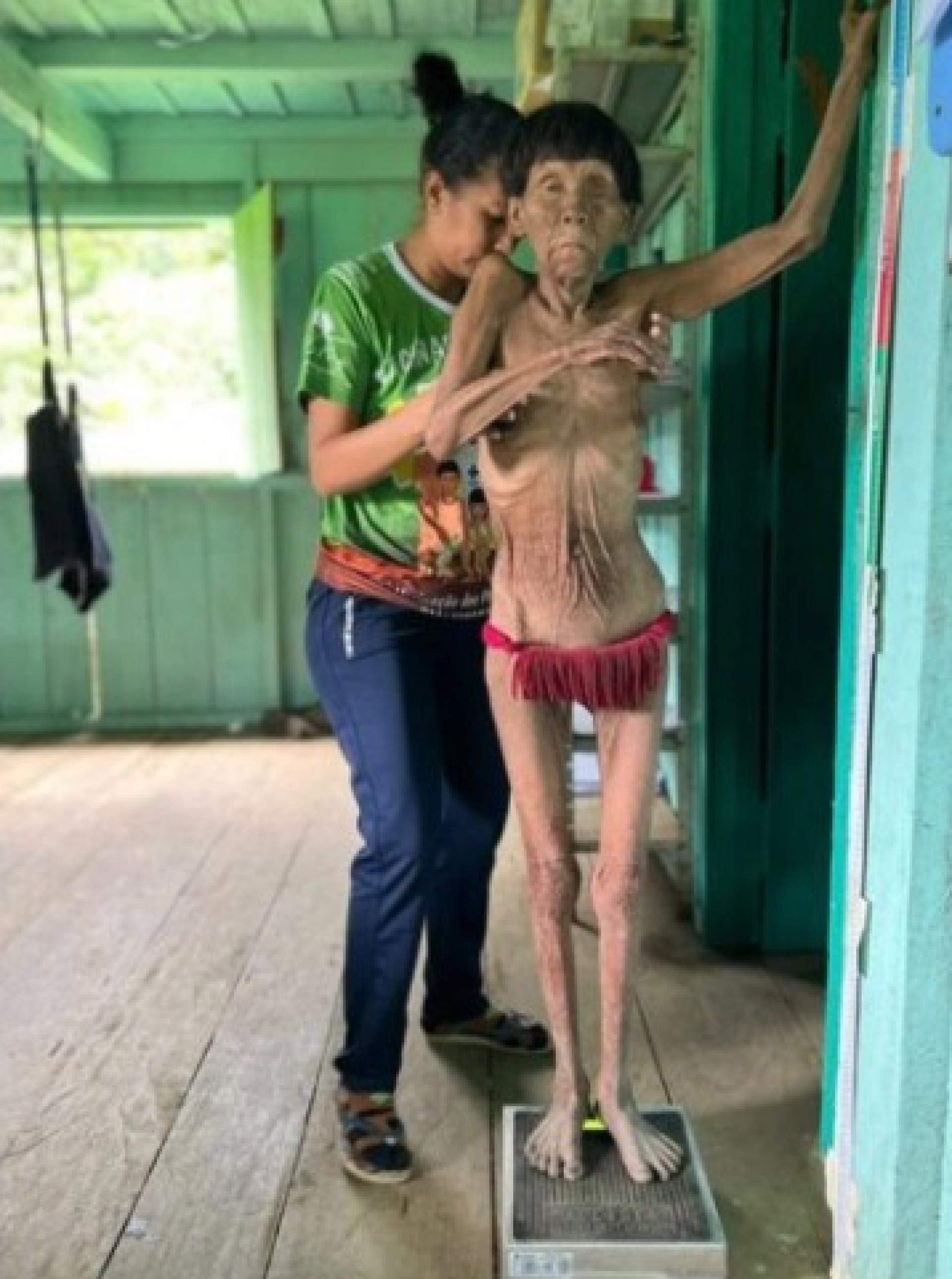 Povo Yanomami morrendo &agrave; mingua pelo descaso