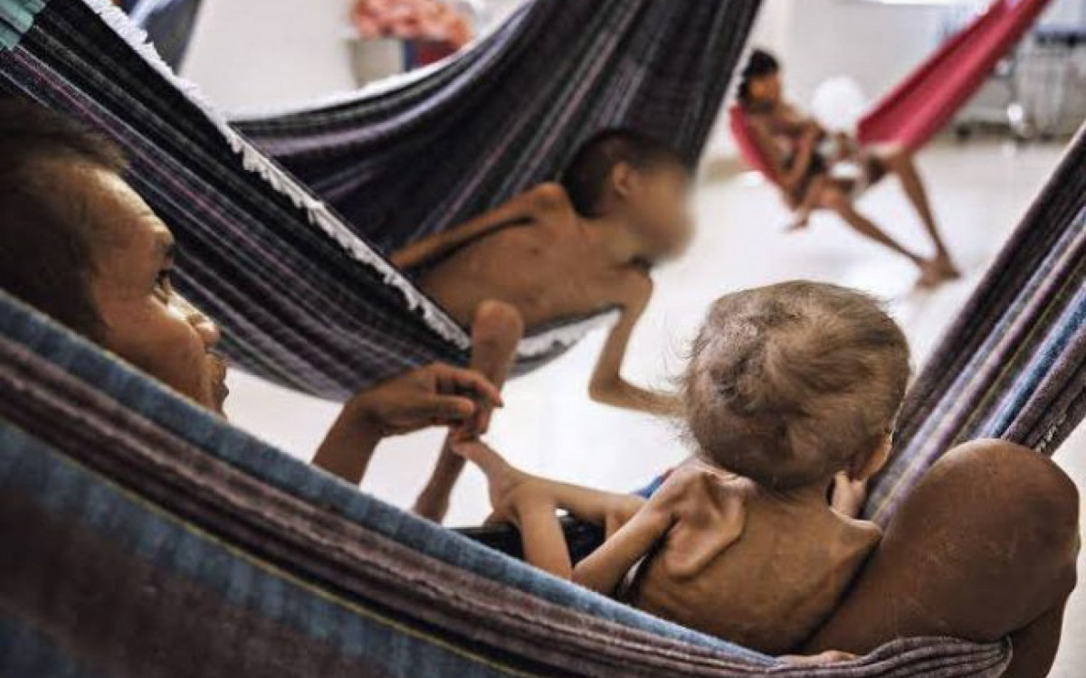 Crianças Yanomami com doenças como como malária, pneumonia, desnutrição, e contaminação por mercúrio  - Reprodução 