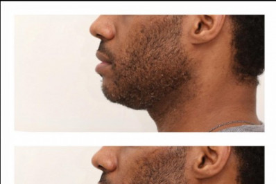 Marido de Fred Nicácio mostra queixo do médico antes da harmonização facial: 'Mais alguma queixa?'