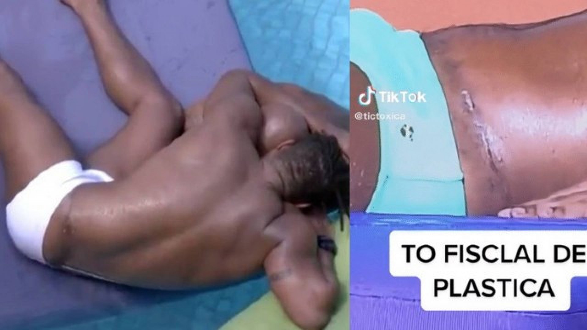 Internautas questionam abdominoplastia após verem cicatrizes em Fred Nicácio - Reprodução Internet