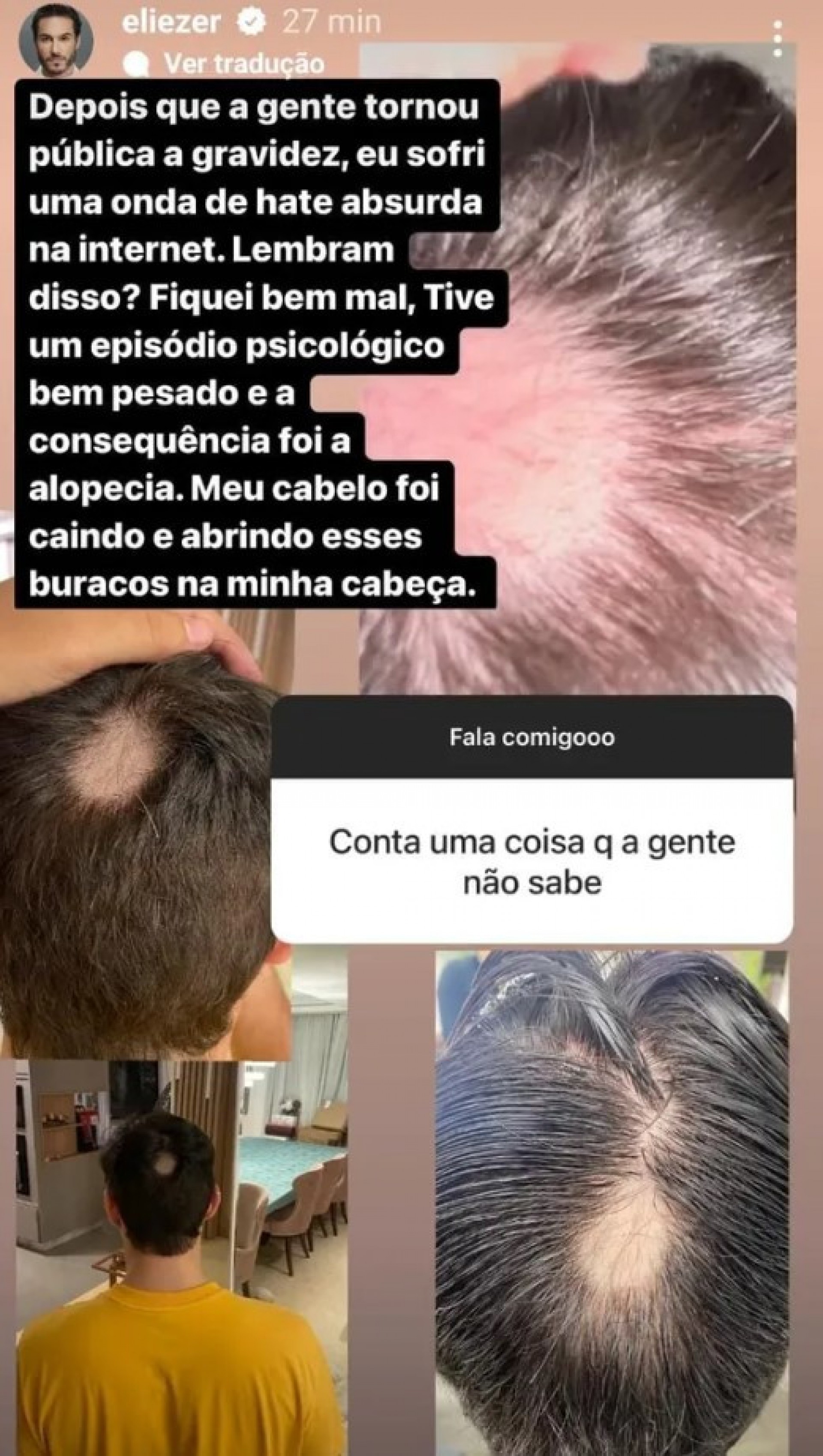 Eliezer revela que já teve alopecia - Reprodução/Instagram