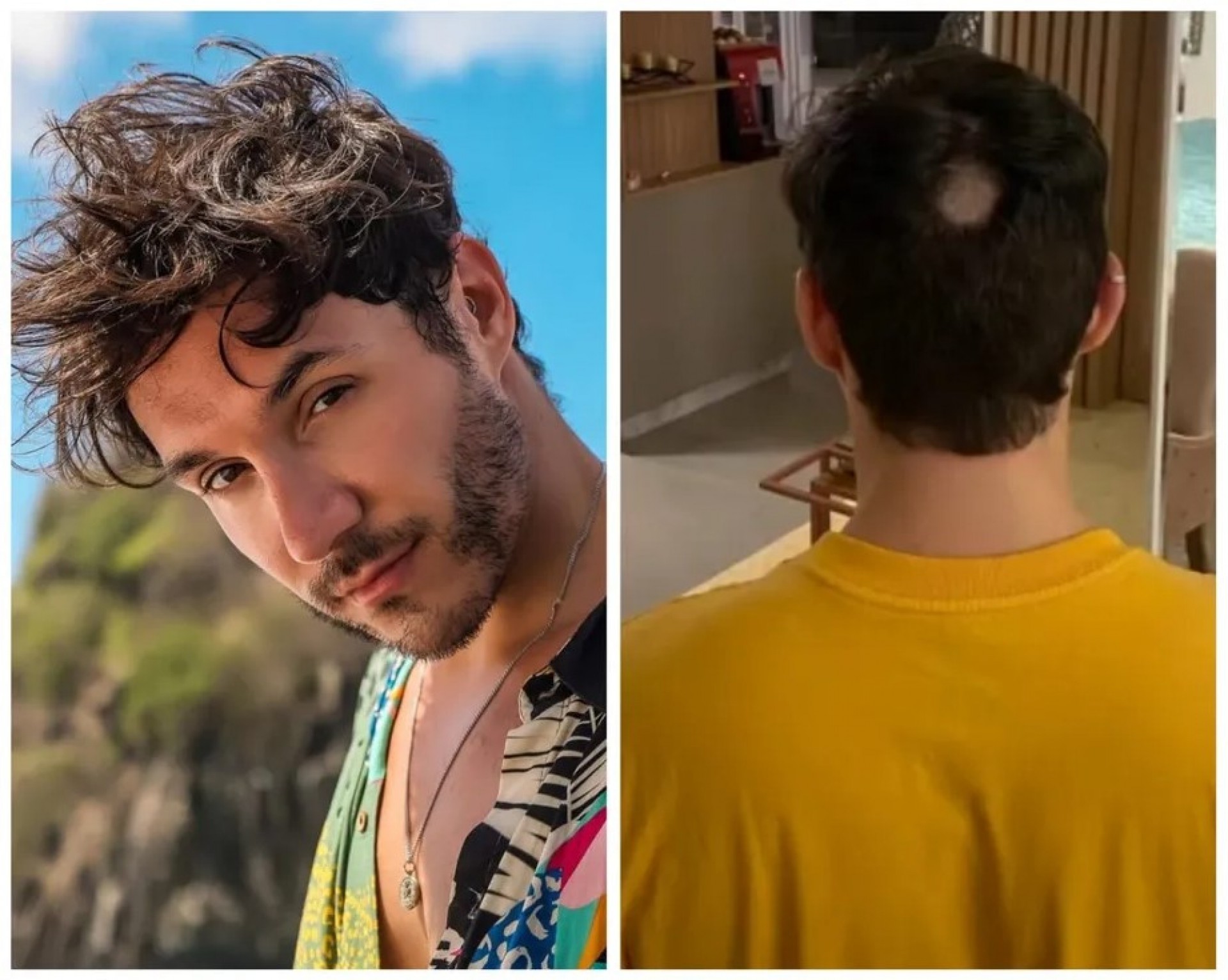 Eliezer revela que já teve alopecia - Reprodução/Instagram