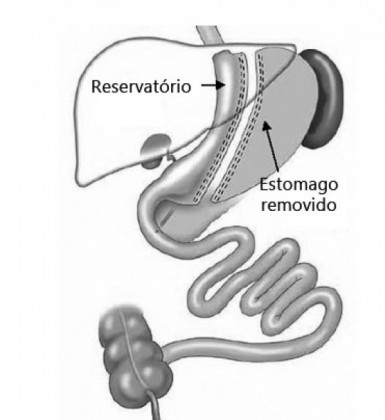 Procedimento de gastrectomia vertical - Fonte: Site IFSO