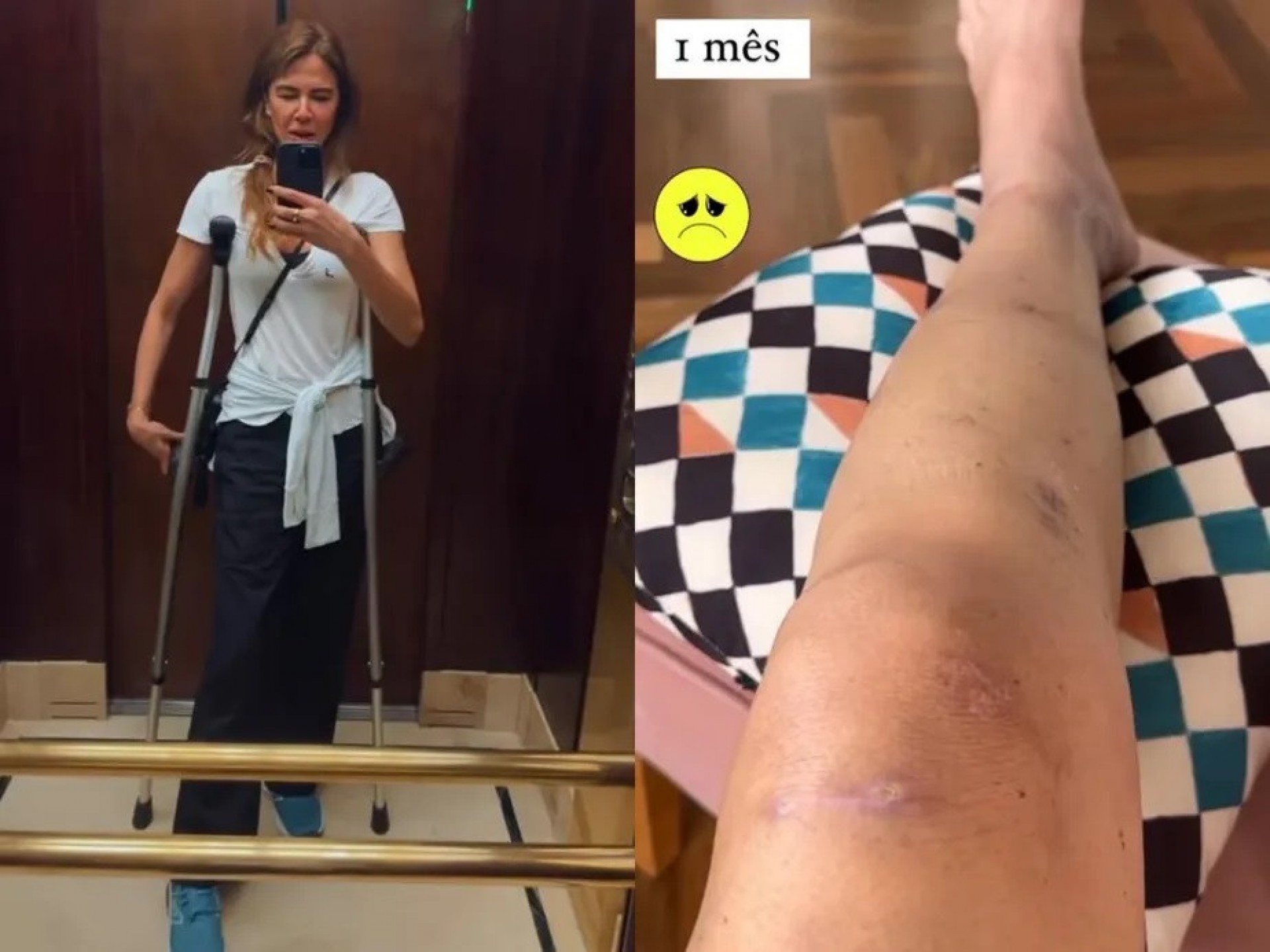 Luciana Gimenez mostra a perna após um mês do acidente - Reprdução / Instagram