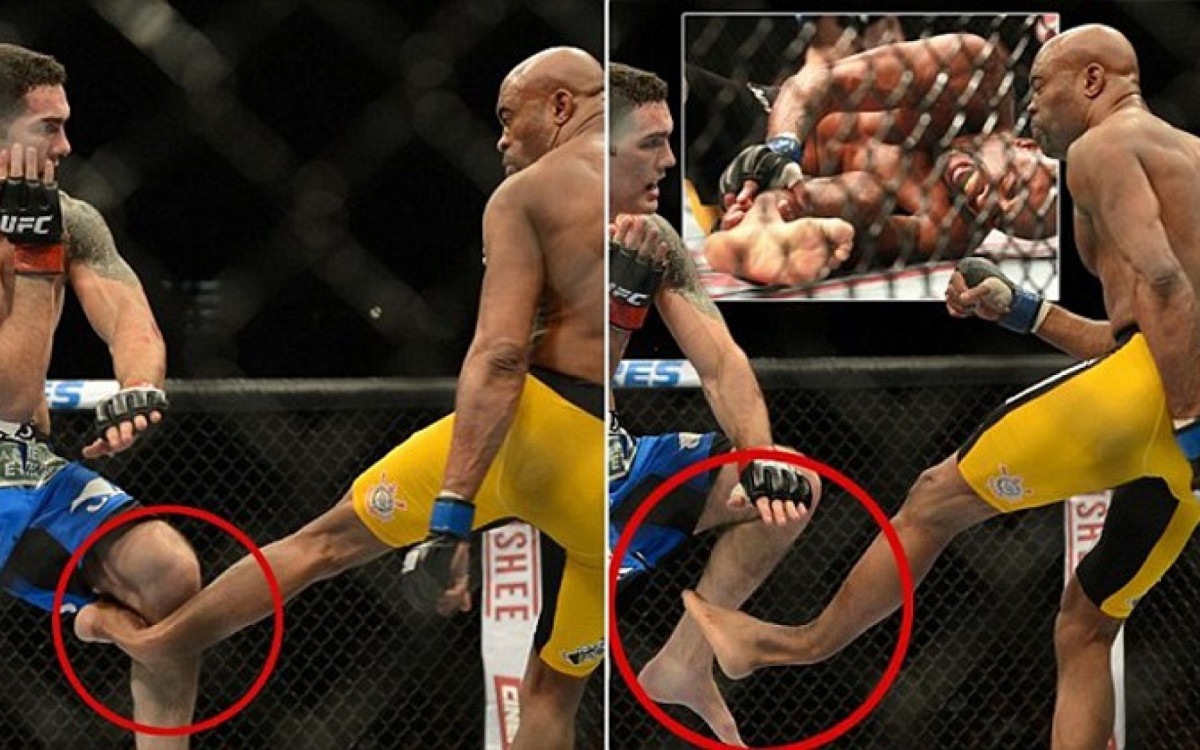 Les&atilde;o de Anderson Silva, em 2013, chocou o mundo do MMA