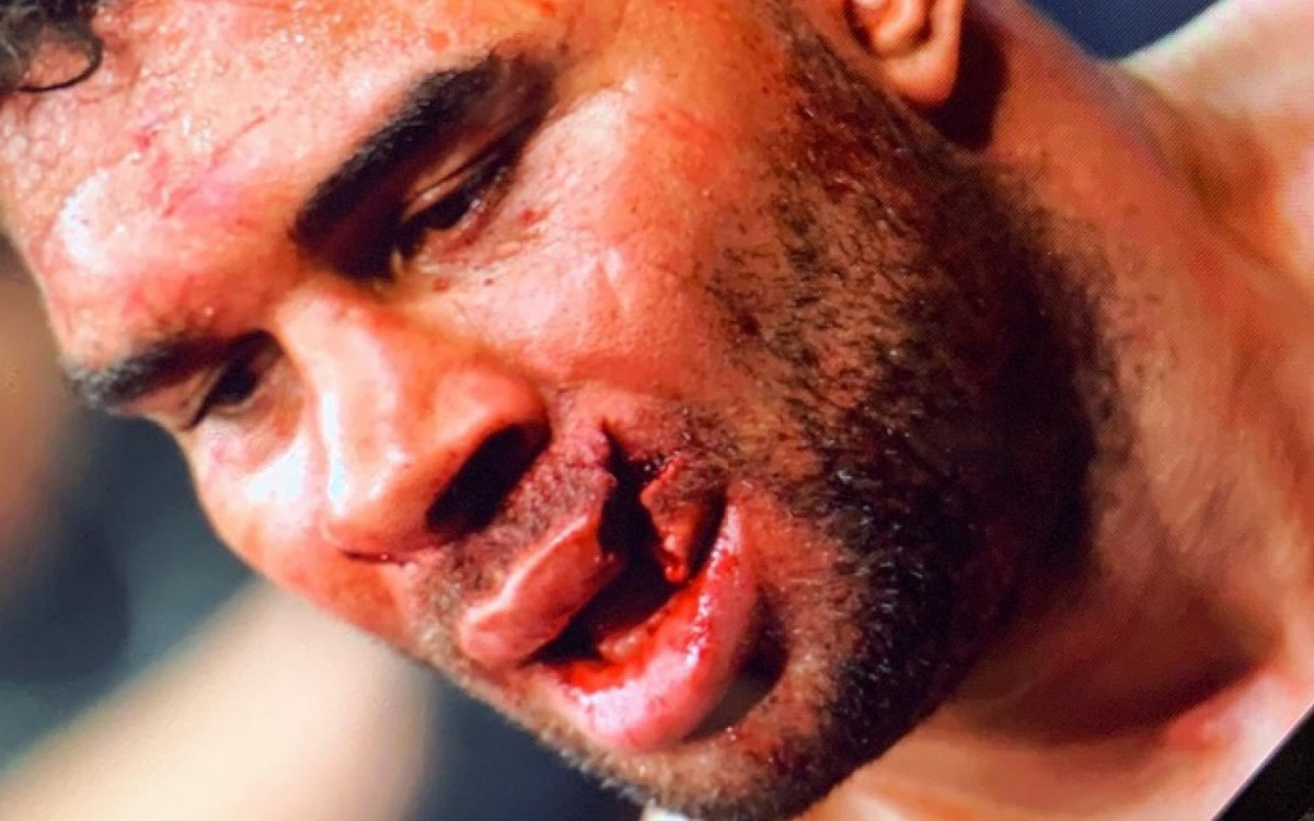 Overeem teve um corte bizarro no l&aacute;bio e passou por cirurgia depois