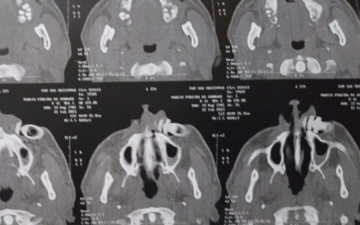 Exame de imagem mostra projetil alojado