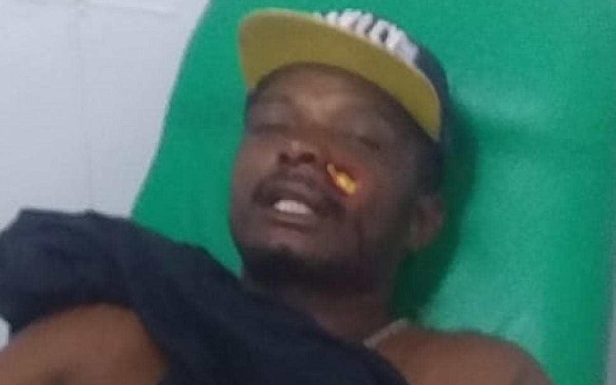 Bala de borracha ficou alojada no rosto do ambulante