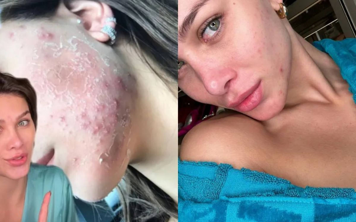 Fl&aacute;via Pavanelli exp&otilde;e registros de seu tratamento contra a acne