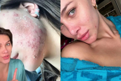 Flavia Pavanelli mostra registros de sua jornada contra acne: 'Muito difícil'