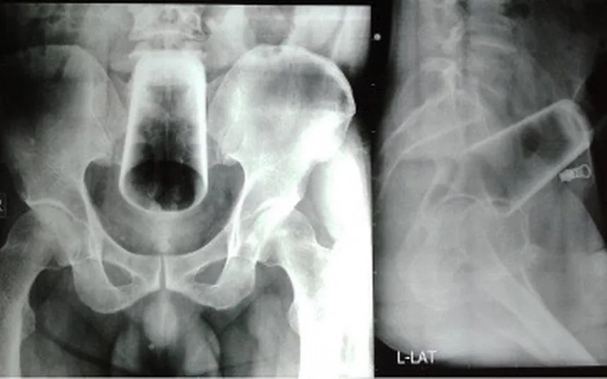 A man undergoes surgery to remove a 12 cm cup from his anus |  world and science