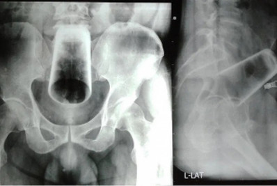 Homem é submetido a cirurgia para remover copo de 12cm do ânus