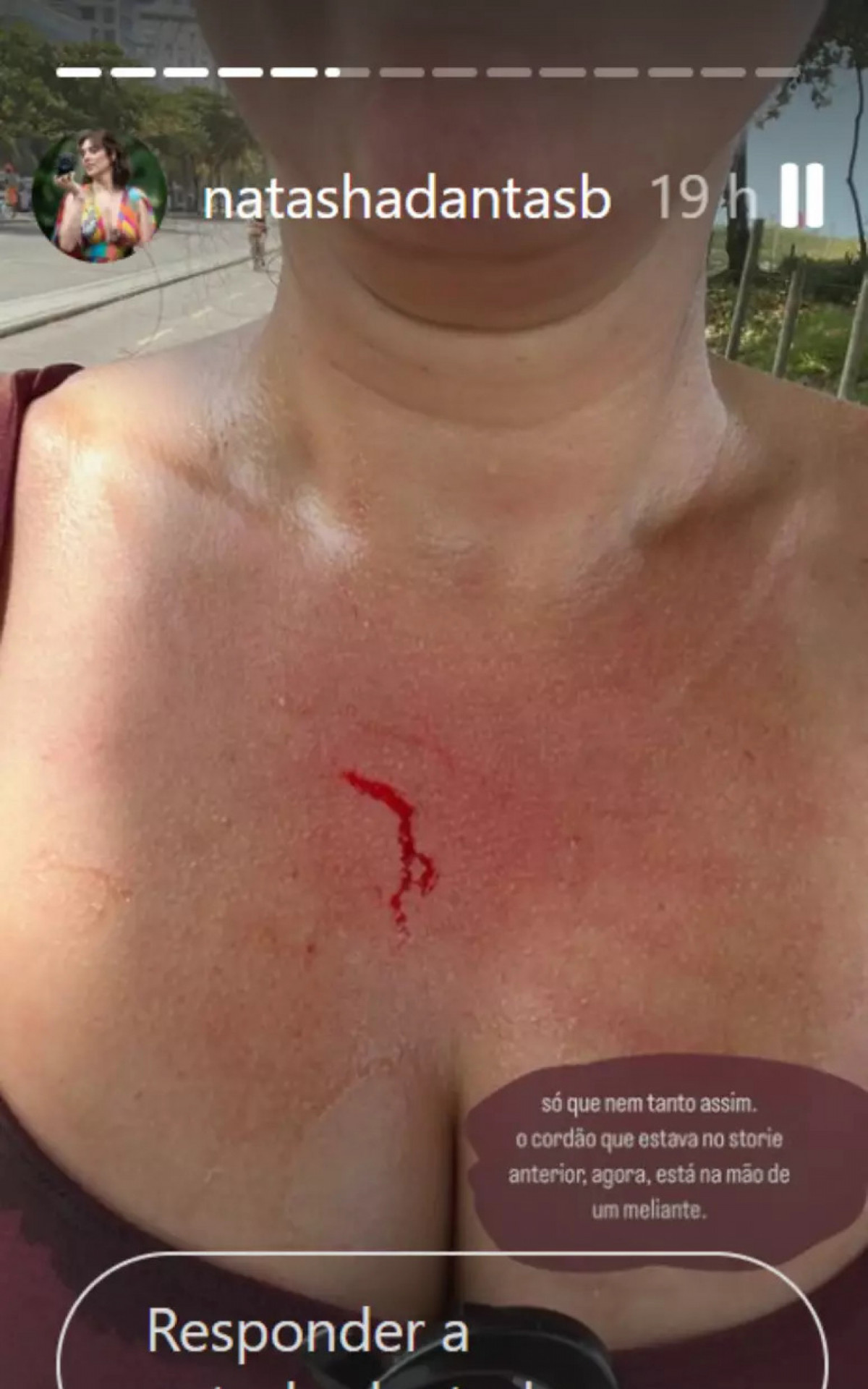 Natasha ficou ferida após o furto - Reprodução/Instagram