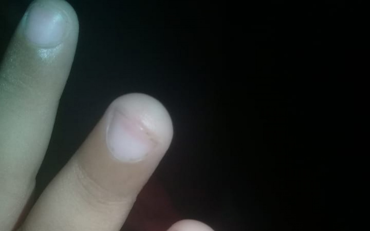 A beb&ecirc; Lara Adriana Oliveira de Souza, de 1 ano e 8 meses, ter&aacute; que passar por nova cirurgia por conta de osso exposto