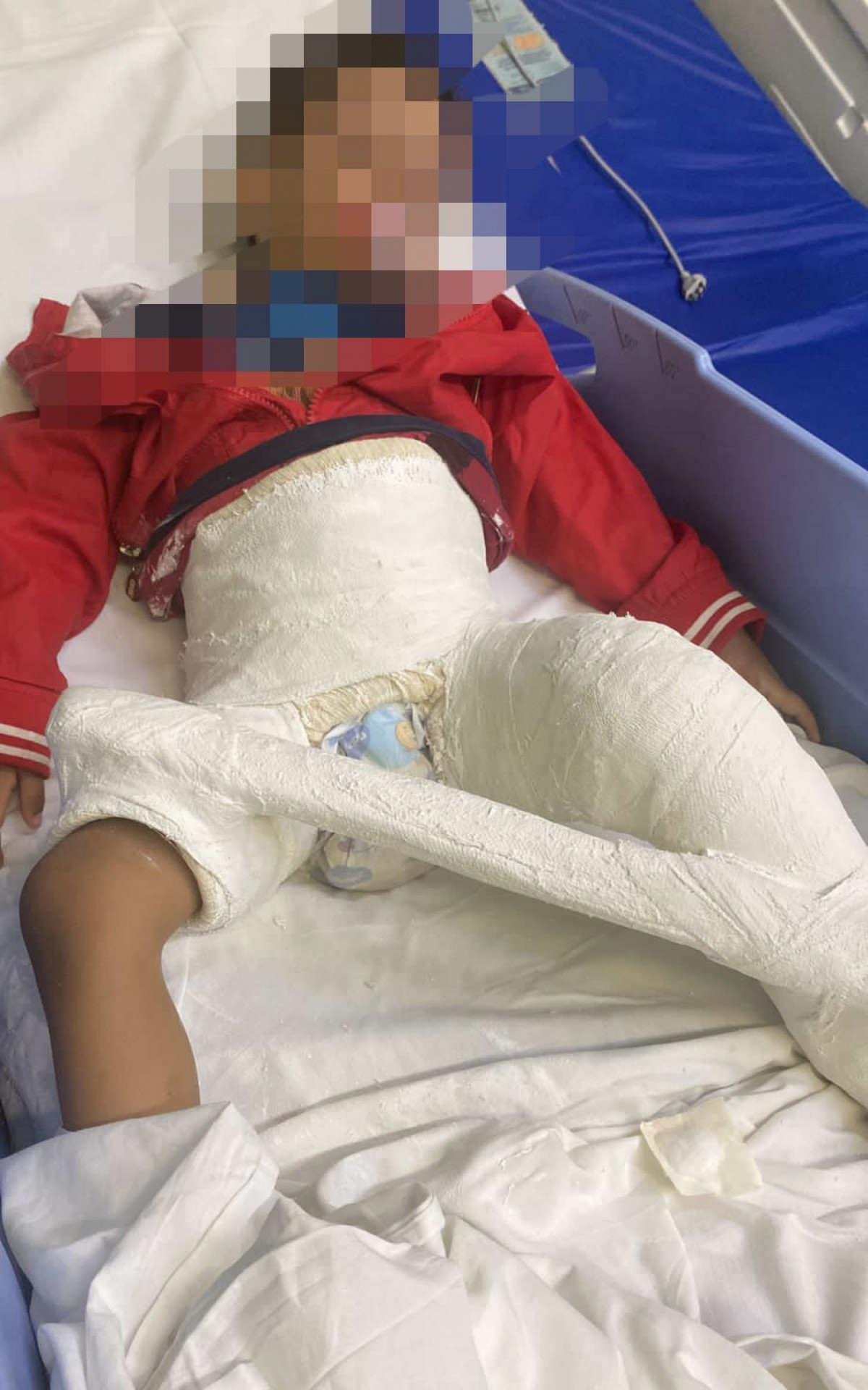 A criança caiu da escada e machucou a perna - Arquivo Pessoal