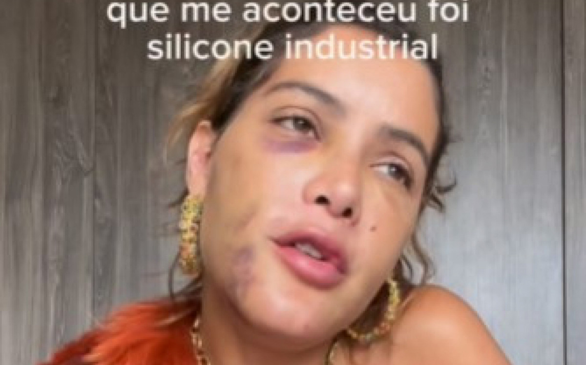 Atriz Enfrenta Problemas No Rosto Por Aplicação De Silicone Industrialatriz Enfrenta Problemas