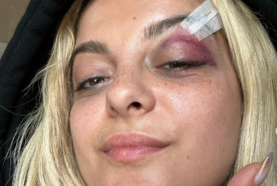 Bebe Rexha exibe hematomas nos rosto após ser atingida por celular em show 