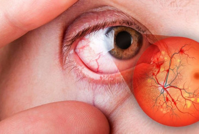 UFF pesquisa tratamentos efetivos contra a retinopatia diabética
