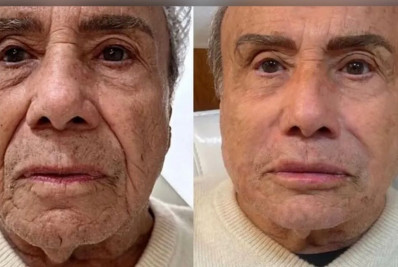 Especialista explica prazo e cuidados da harmonização facial realizada por Stenio Garcia