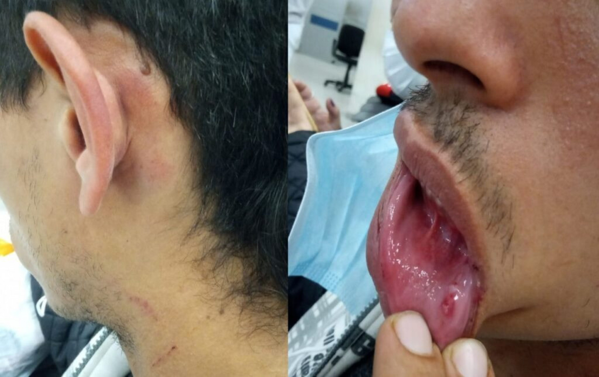 Homem sofreu v&aacute;rias escoria&ccedil;&otilde;es e hematomas devido a agress&atilde;o - Reprodu&ccedil;&atilde;o/Arquivo Pessoal