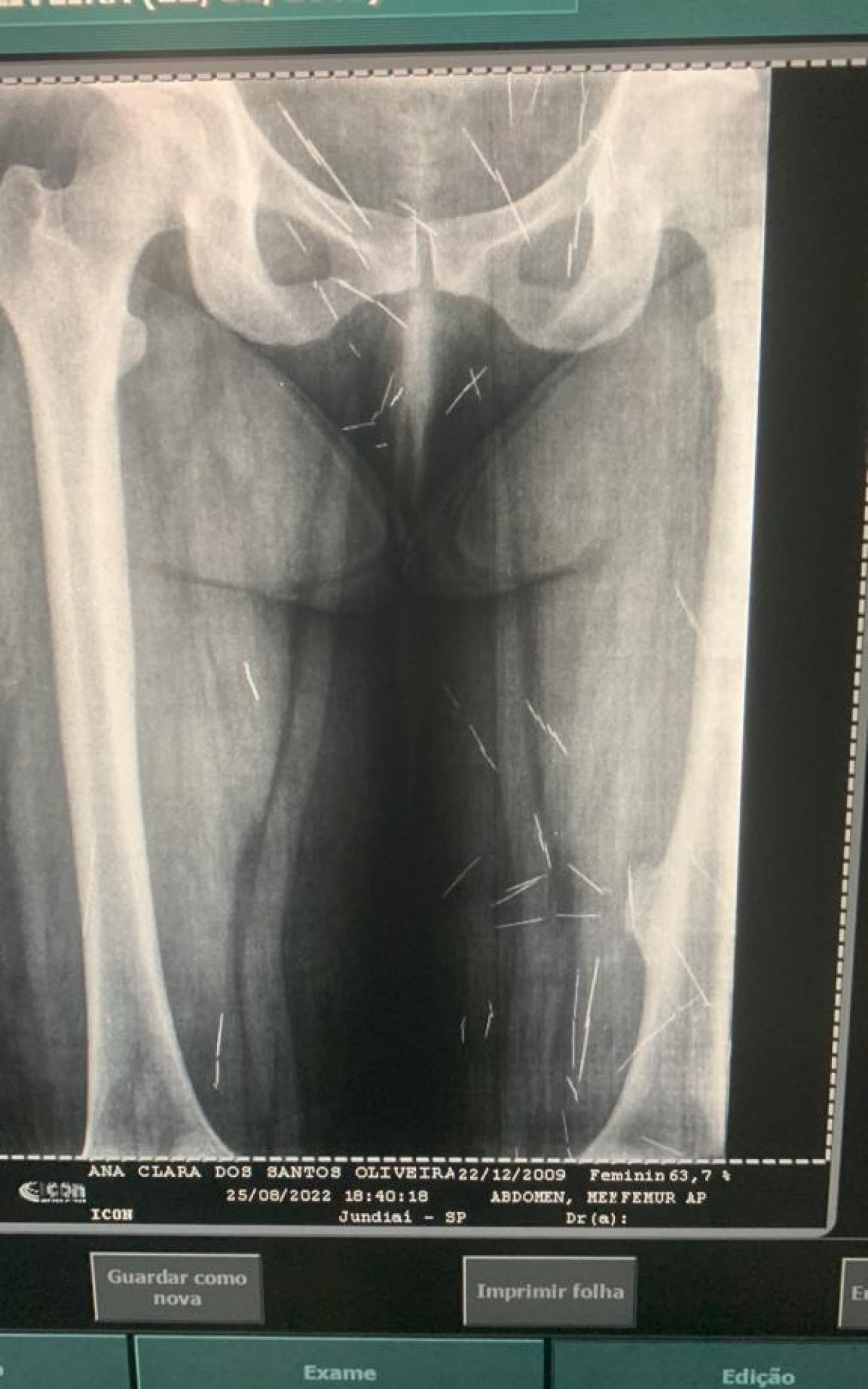 Exames comprovam que a estrutura óssea pertence a uma adulta - Divulgação