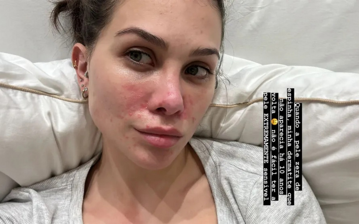 Flavia Pavanelli exp&otilde;e crise de dermatite