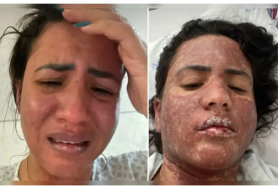 Mulher de Frank Aguiar surge com corpo todo queimado; Entenda