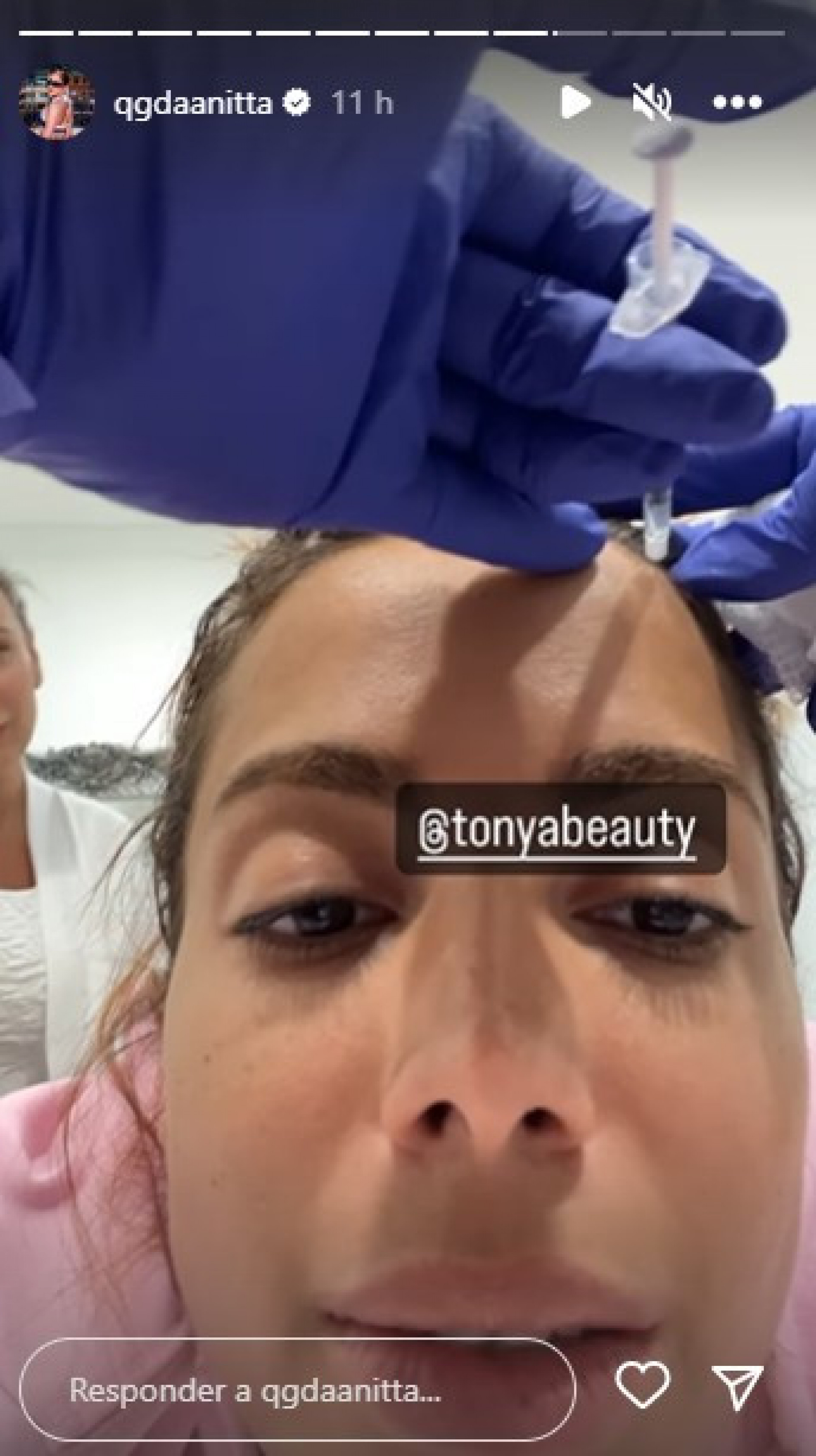 Anitta dá detalhes de procedimento estético - Reprodução/Instagram