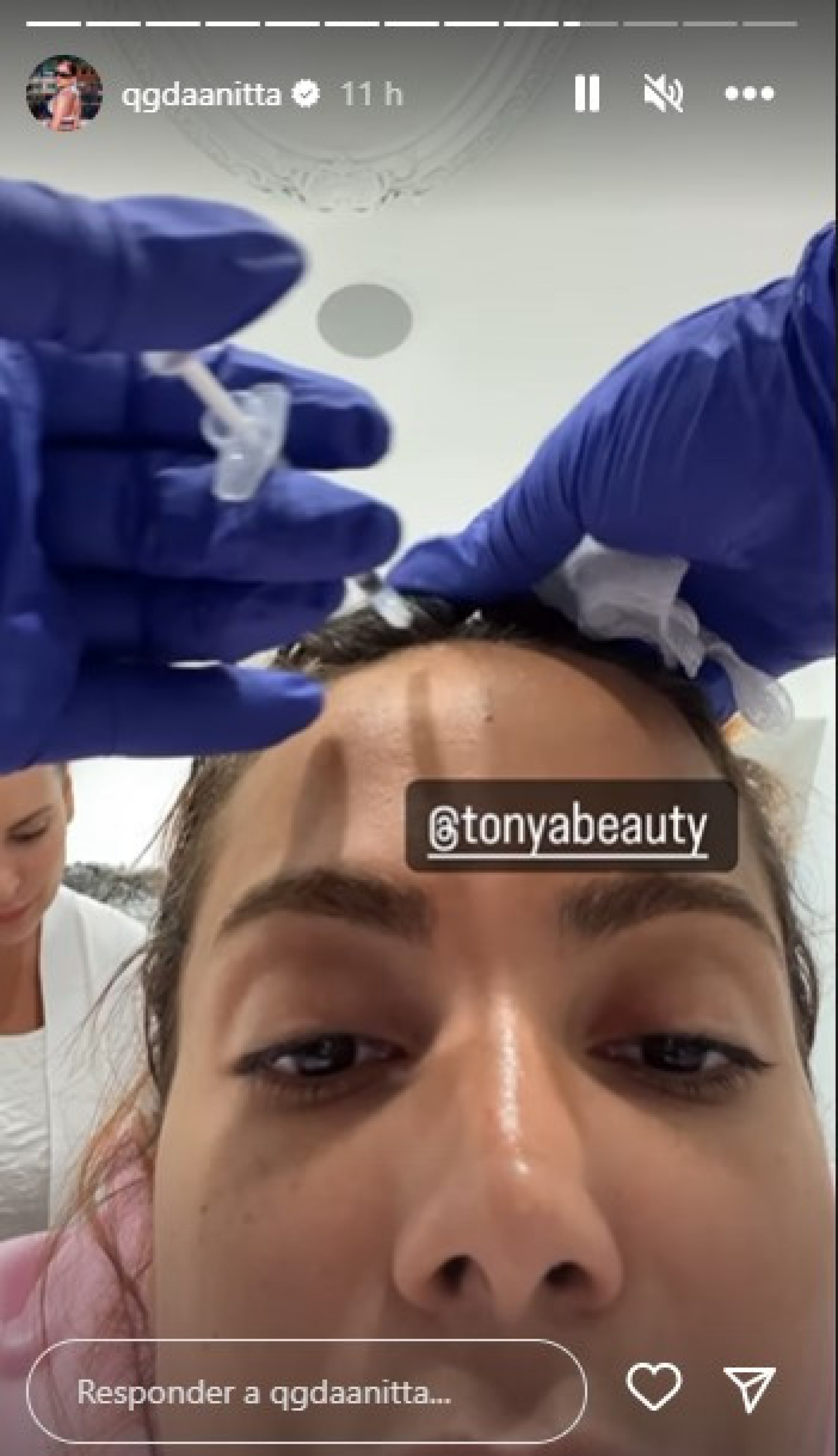 Anitta dá detalhes de procedimento estético - Reprodução/Instagram