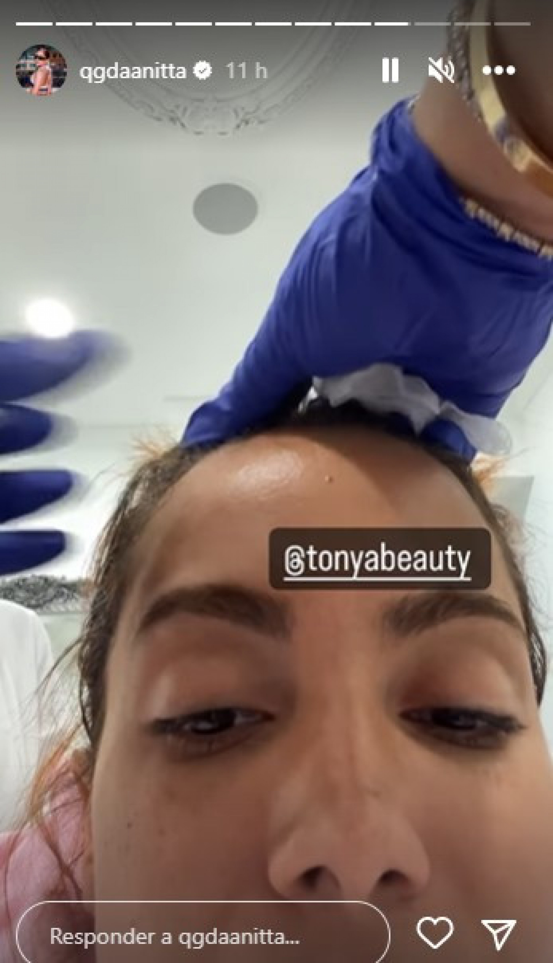 Anitta dá detalhes de procedimento estético - Reprodução/Instagram