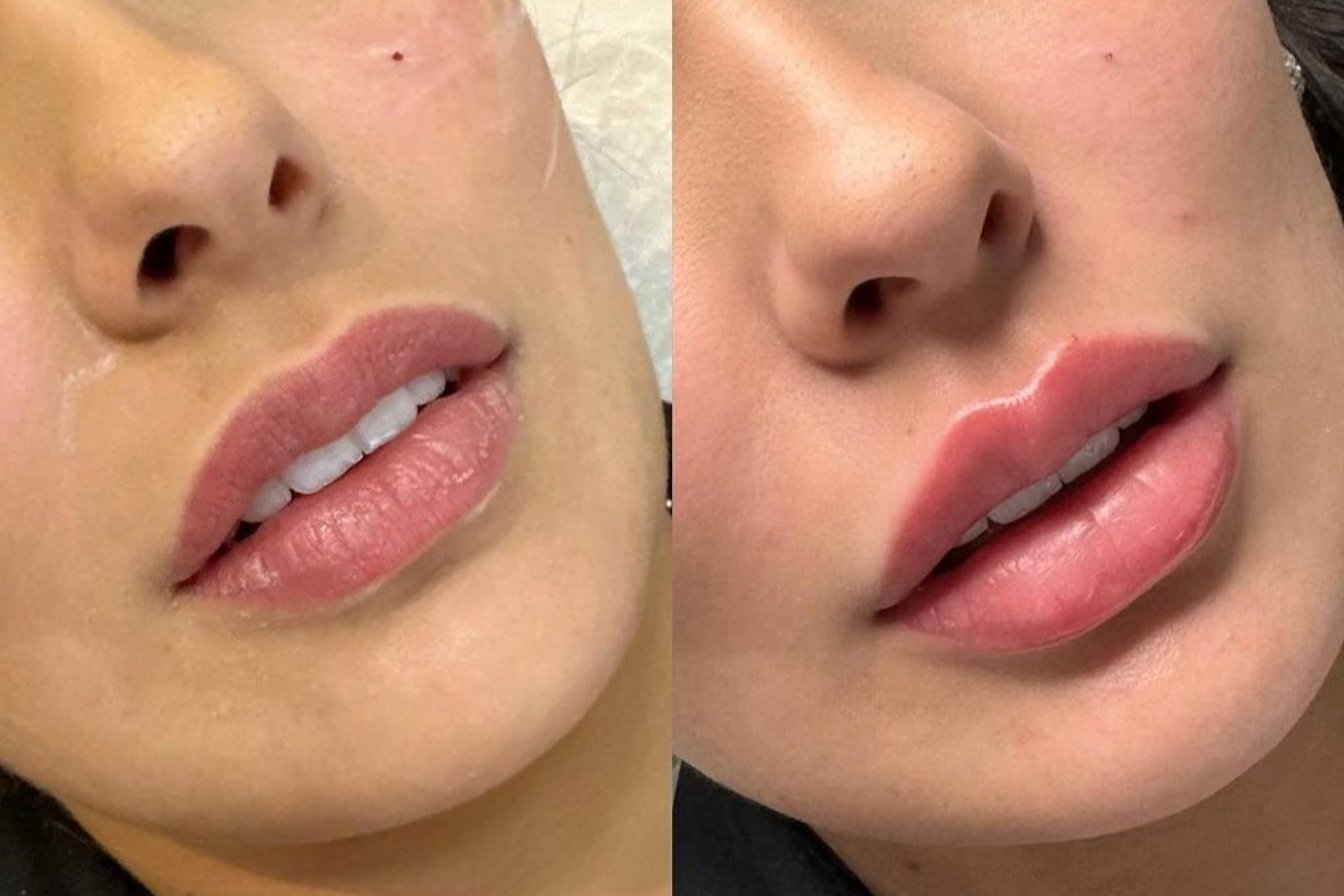 Ex-'BBB' Larissa Santos faz harmonização facial: 'Rejuvenescer' - Reprodução / Instagram