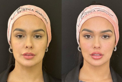 Ex-'BBB' Larissa Santos faz harmonização facial; confira resultado