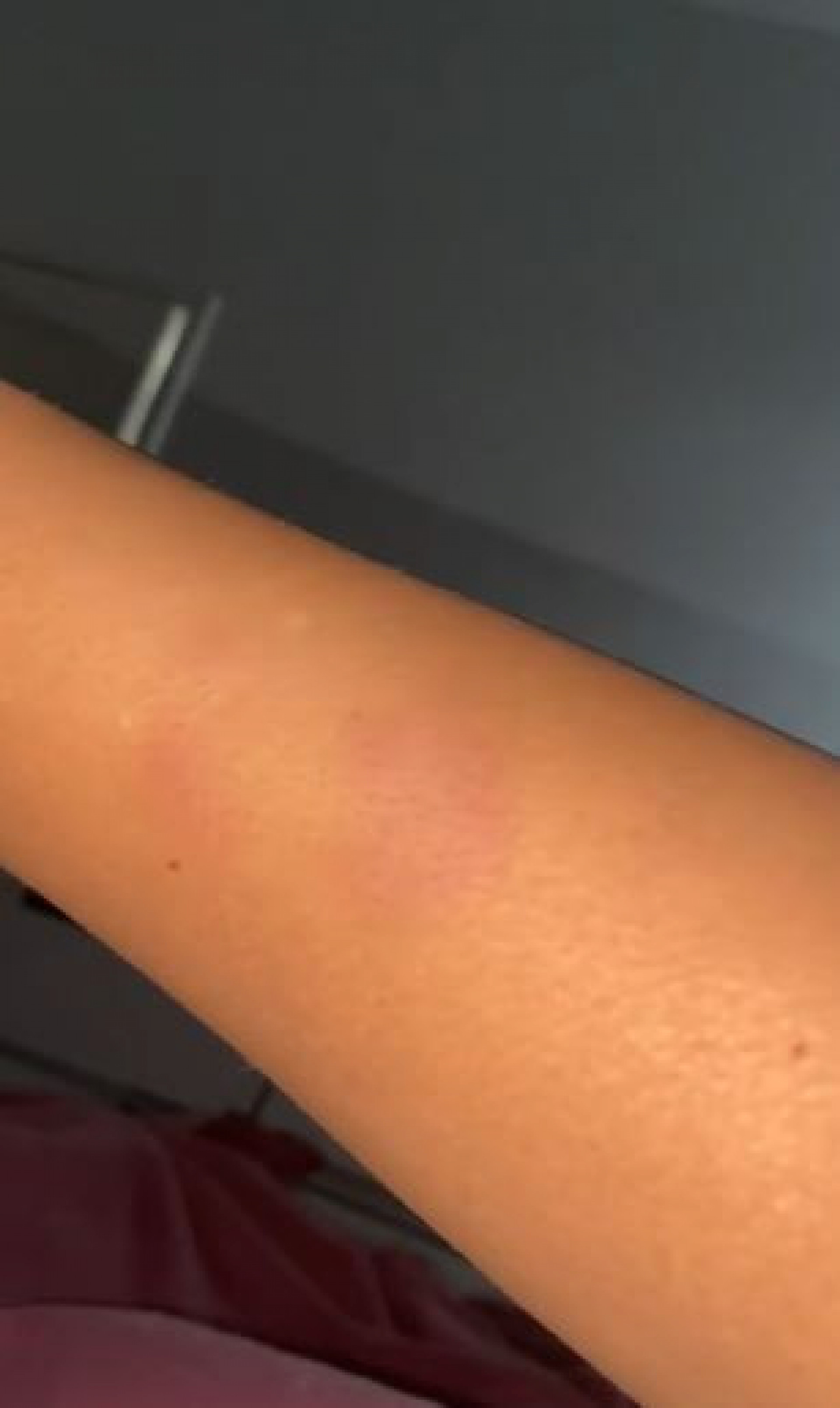 Hematonas ap&oacute;s as agress&otilde;es