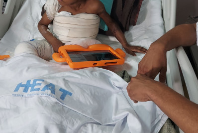 Médicos do Heat alertam para aumento de queimados nesta época do ano