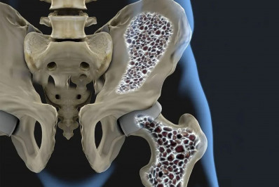 Por que casos de fratura no quadril devem crescer 4 vezes no Brasil? Veja como evitar