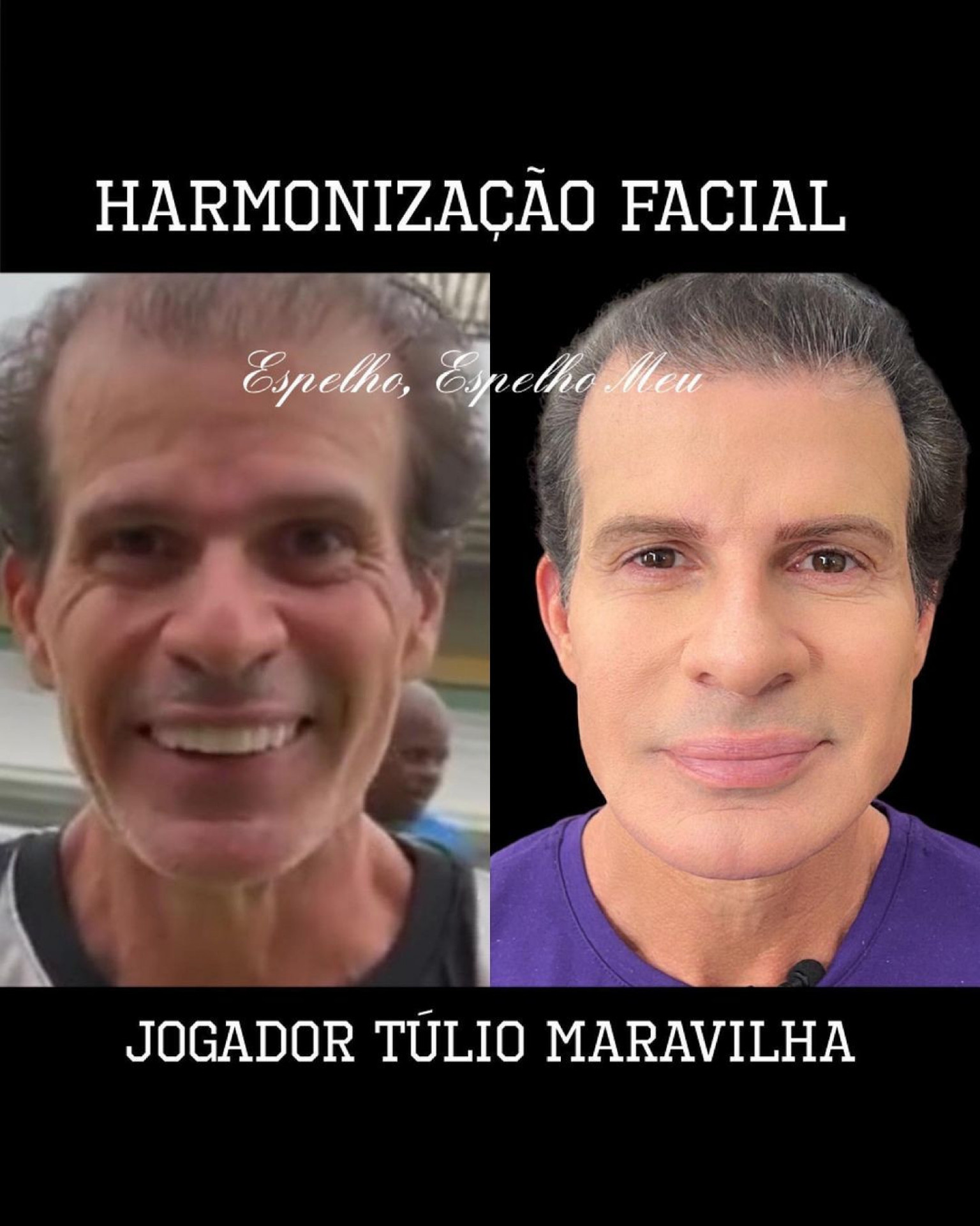 Resultado da harmonização de Túlio Maravilha - Reprodução/Instagram