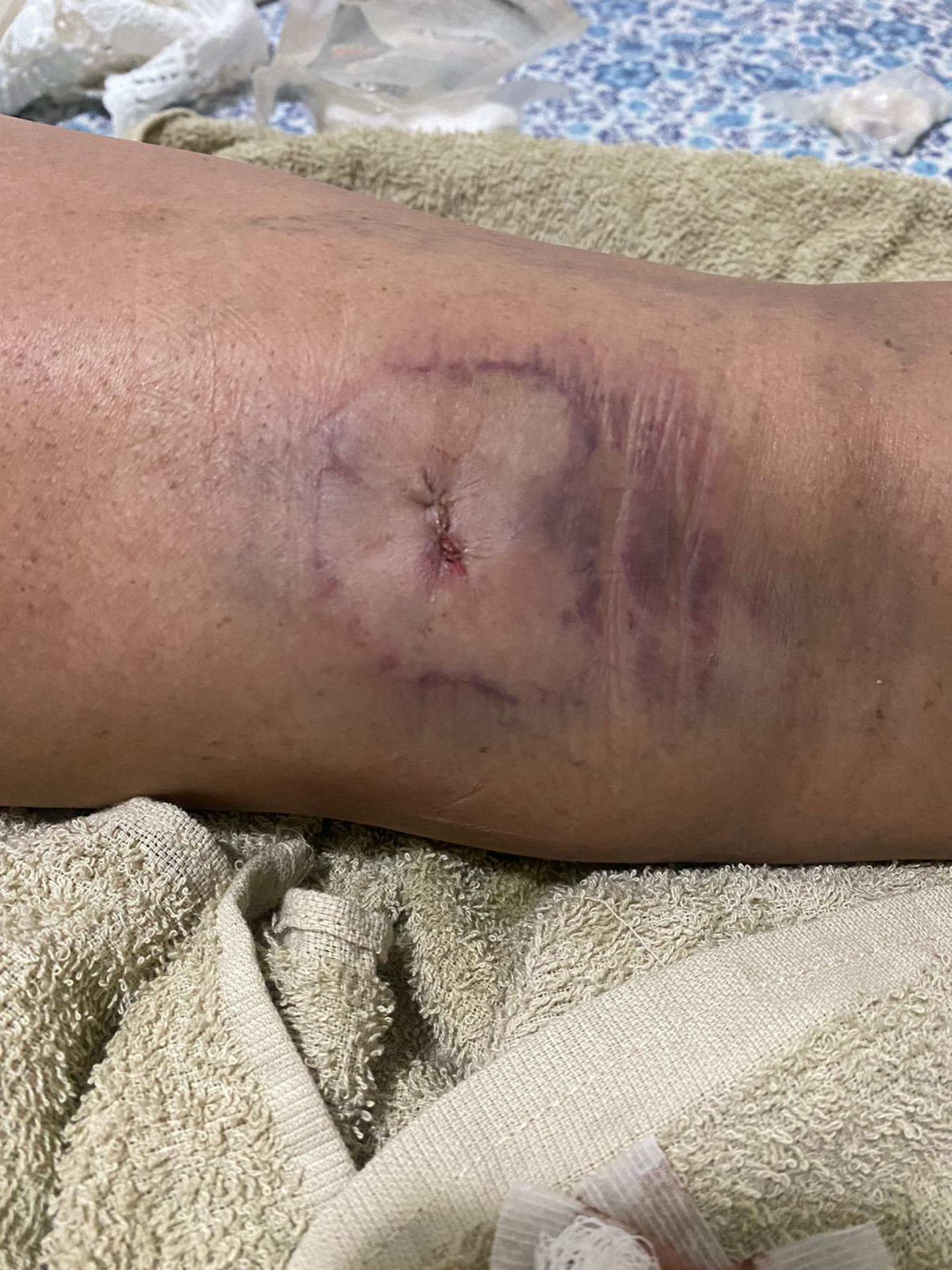 Bala perdida a acertou na perna