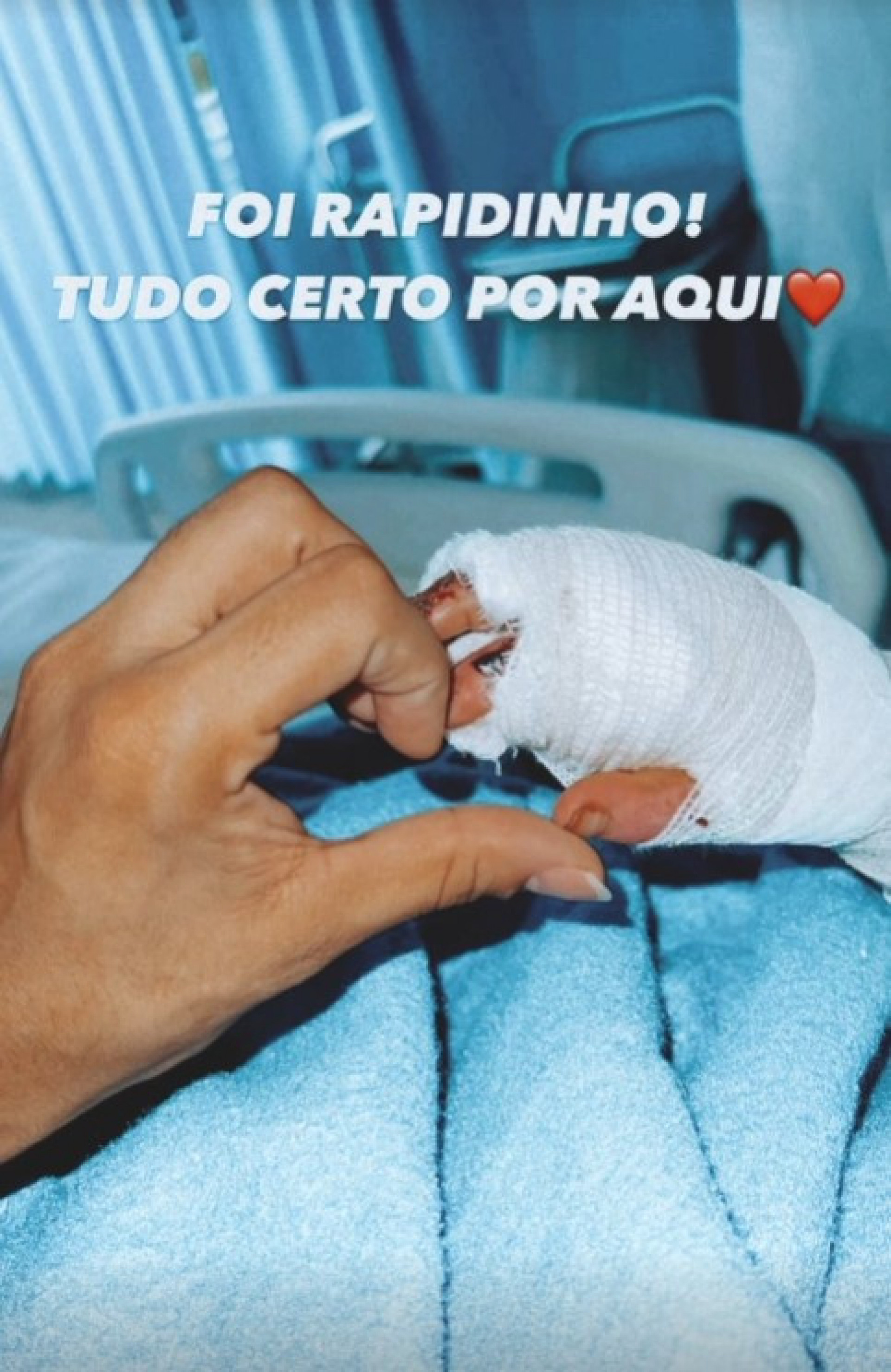 Menina retirou bandagens com curativos para as queimaduras da mão e já movimenta os dedos