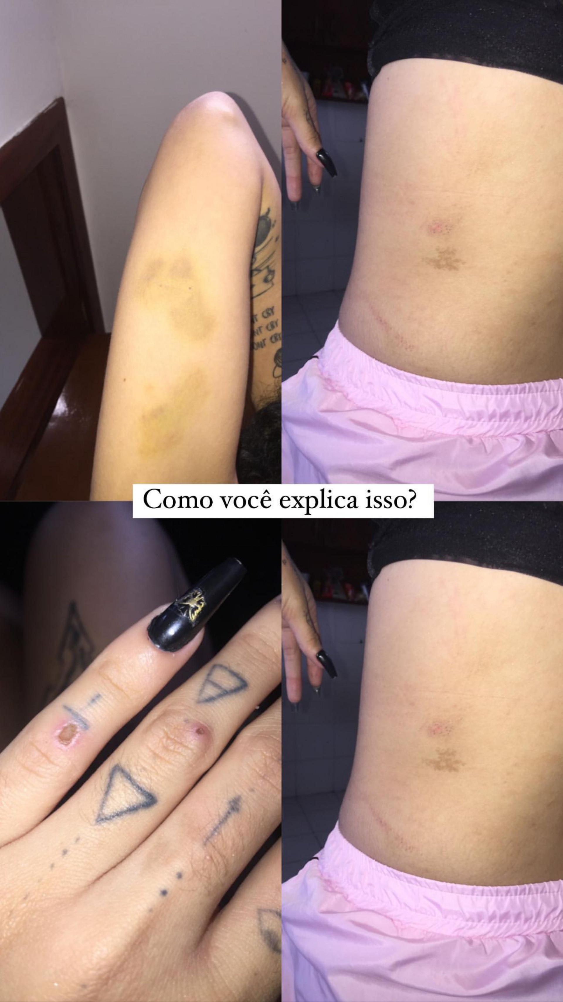 Azzy mostrou hematomas ao denunciar agressões do cantor Ryan Realcria - Reprodução/Instagram