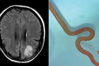 Verme vivo de 8 cm comum em cobras é achado no cérebro humano pela primeira vez