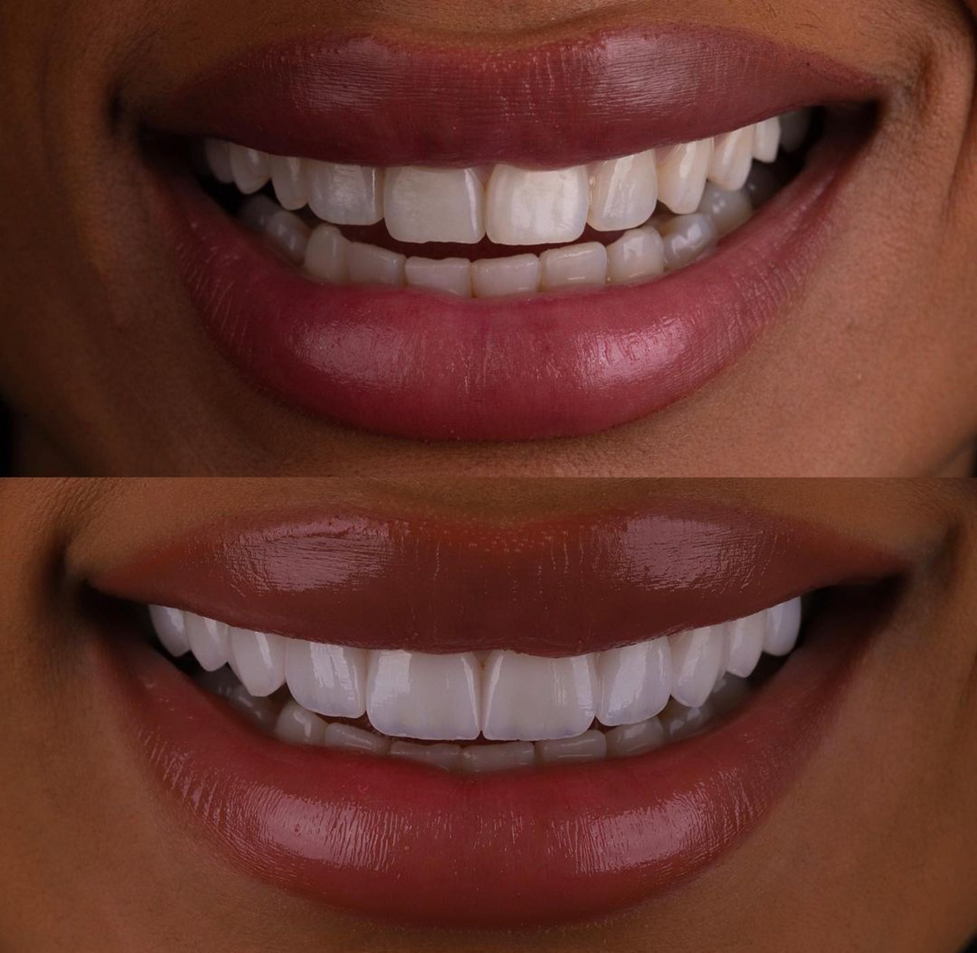 Brunna Gonçalves coloca lentes e mostra novo sorriso - Reprodução/Instagram