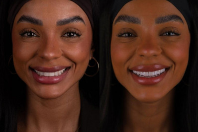 Brunna Gonçalves compartilha transformação no sorriso após colocar lentes