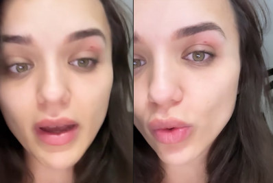 Rafa Kalimann se surpreende ao ser picada por abelha no olho